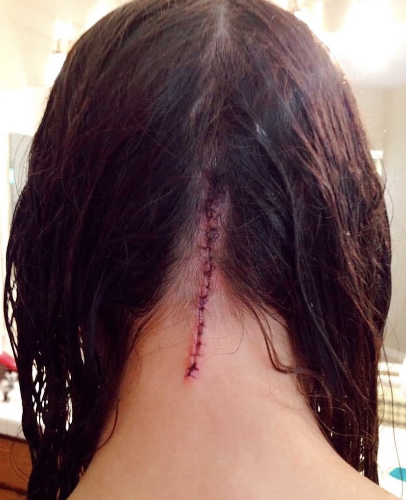 Sarah's scar one week after surgery.