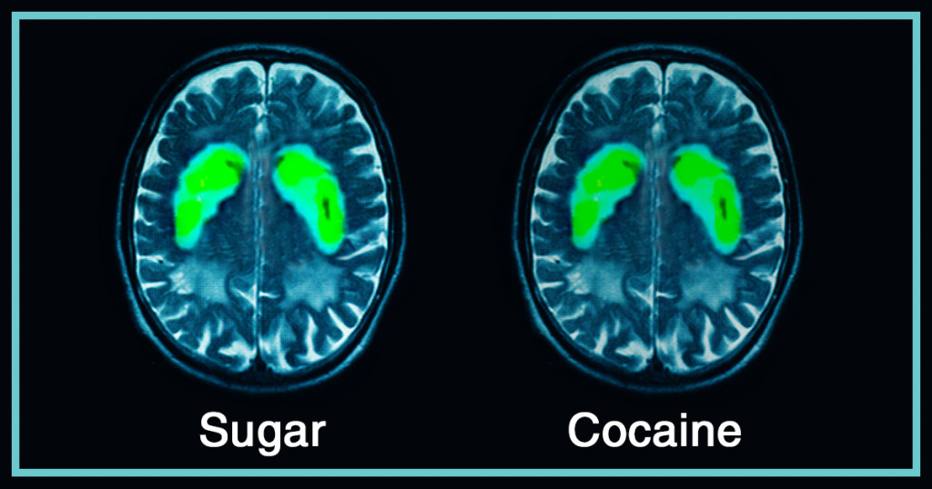 Picture of a brain on sugar compared to a picture of a brain on cocaine